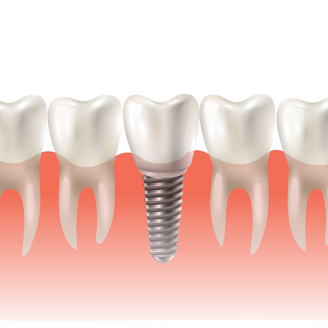 Dr Mozo Implantes dentales