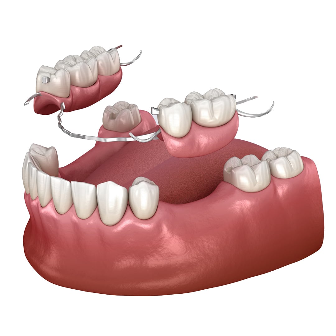 Dr Mozo Implantes dentales